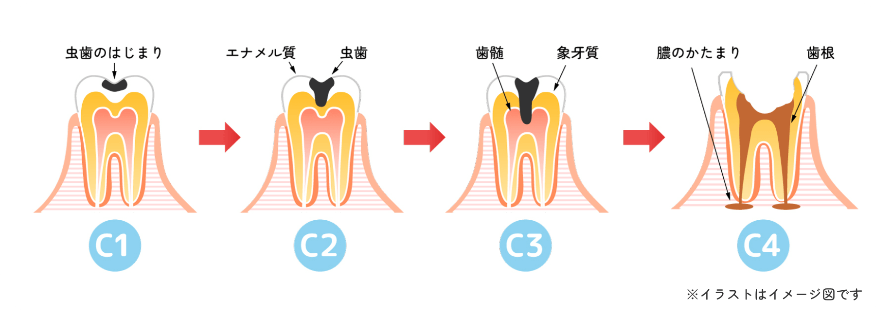 虫歯のイラスト図