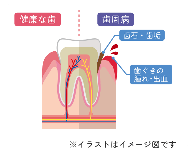 歯周病のイラスト図