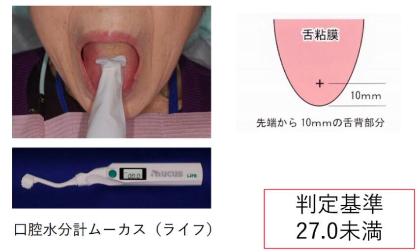 口腔乾燥の評価法の画像